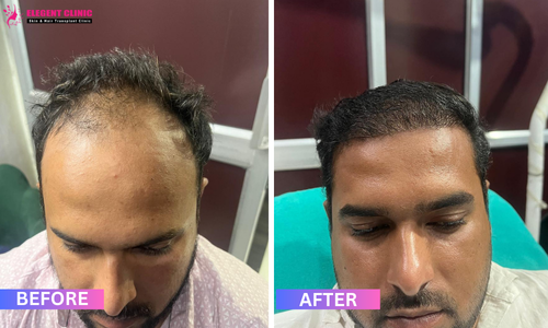 best hair transplant result in patna